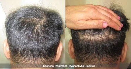 Important Factors of Hair Transplant to get the best treatment