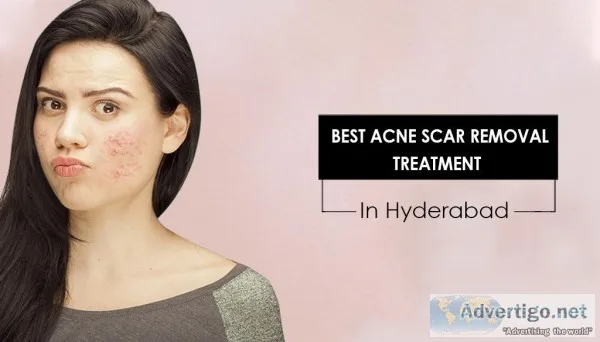 Acne scar removal treatment in Hyderabad