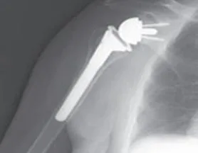 BEST JOINT REPLACEMENT SURGEON IN AHMEDABAD  Dr Tejas Gandhi