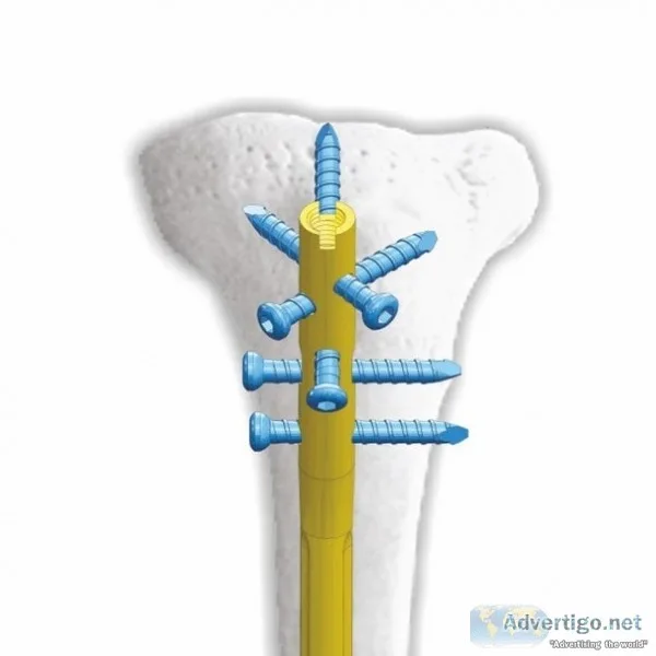 Trauma implant and instruments manufacturer