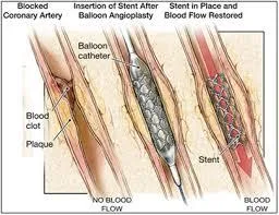 What is a better option for angioplasty A bare metal stent or a 