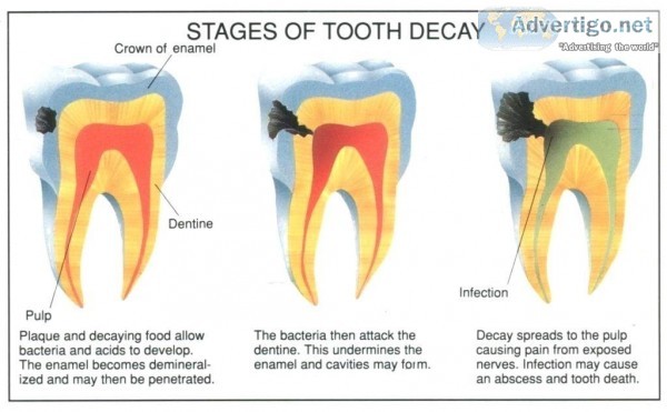 Root canal treatment cost in Gurgaon