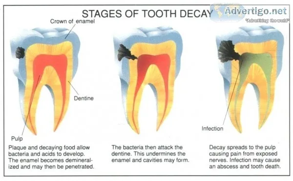 Root canal treatment cost in Gurgaon