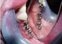 Get Transfer healing abutment