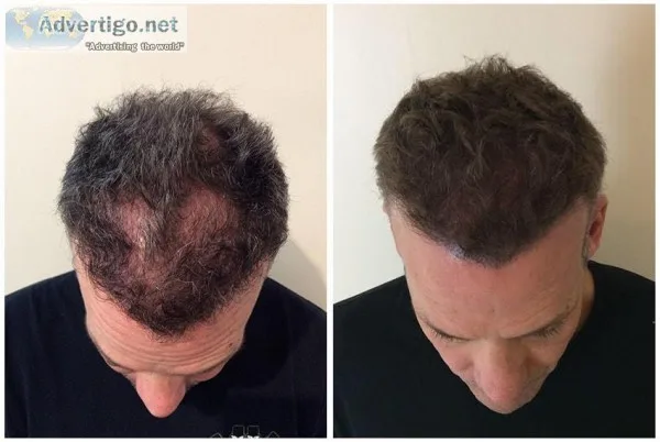SMUK Offer Scalp Micropigmentation Treatment