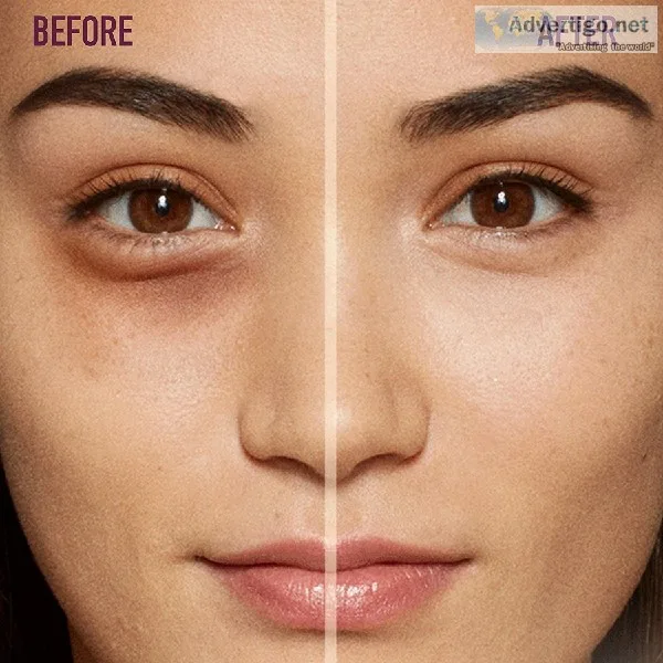 SMUK Provide Dark Circle Treatment in Delhi