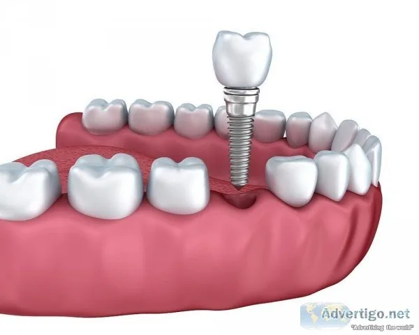 DentalTooth Implant Cost in Ahmedabad India