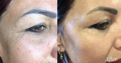 Marvelous skin care containing blue scoprion peptide