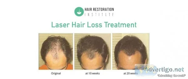 Laser Hair Loss Treatment in Minnesota