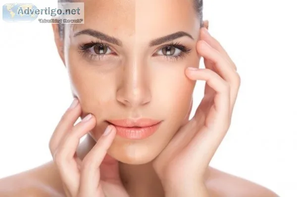 Skin Pigmentation Treatment and Remedy - SMUK
