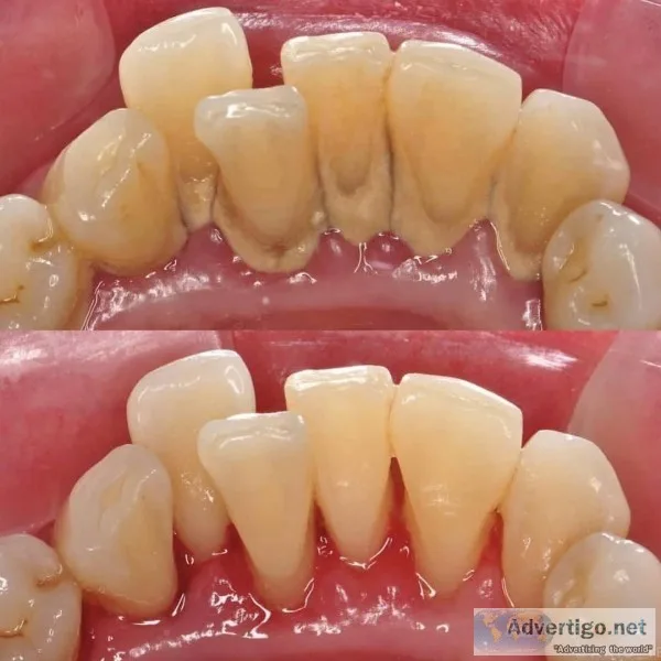 Dental Hygiene Cleaning