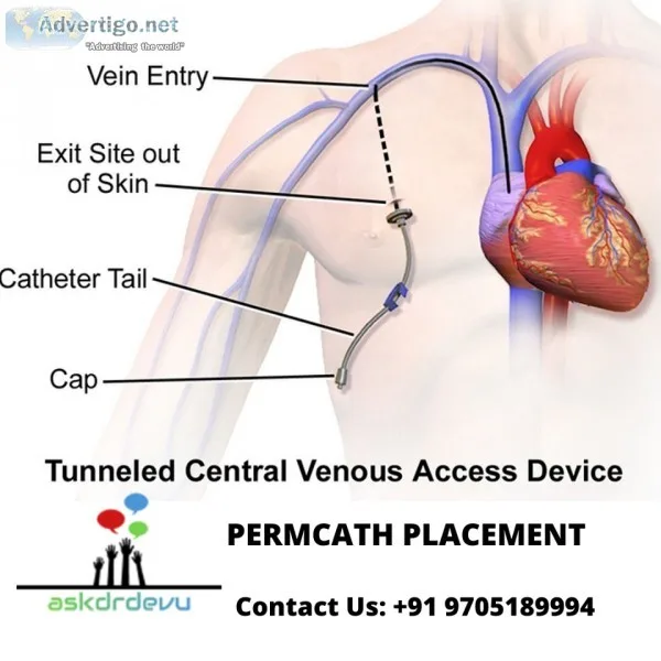 Ask dr devu aovarian vein syndrome symptoms bronchial artery emb