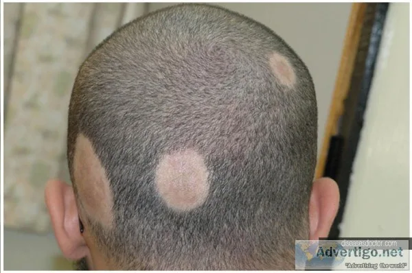 Best alopecia areata treatment clinic in delhi