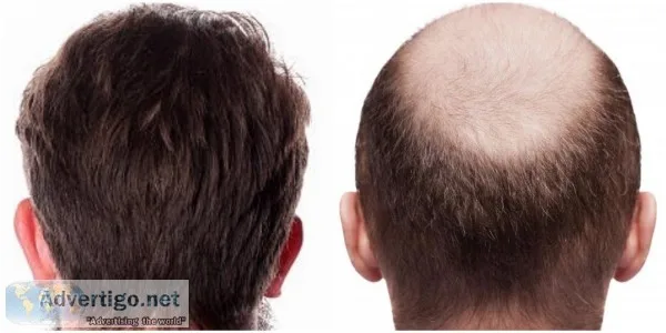 Fue treatment in kamla nagar - satya hair clinic