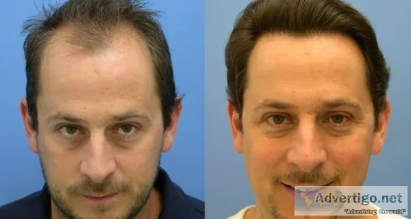 Follicular unit transplant - fut treatment in delhi