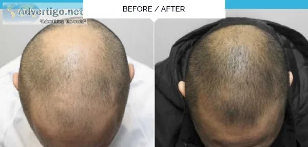 Stem cell therapy for hair loss in delhi
