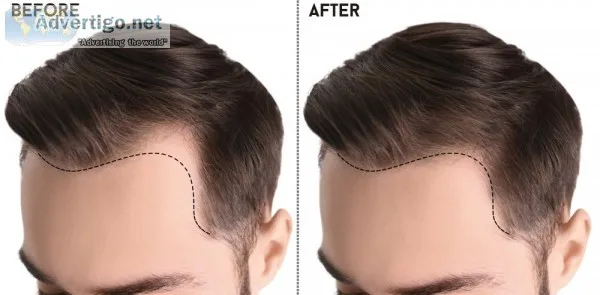 Stem cell therapy for hair loss in delhi