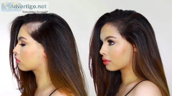 Post partum hair loss treatment delhi - satya skin & hair clinic