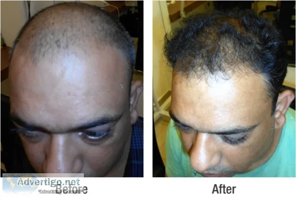 Hair loss treatments for men- satya skin & hair clinic