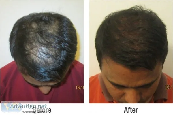 Hair loss treatments for women- satya skin & hair clinic