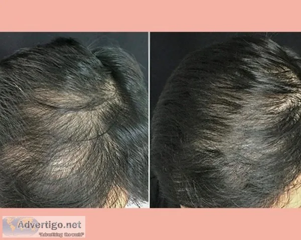 Best PRP Hair Loss Treatment in Chennai