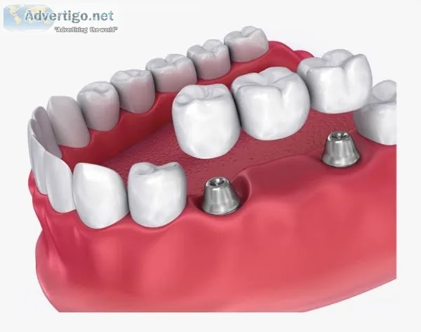 Bridge & crown treatment