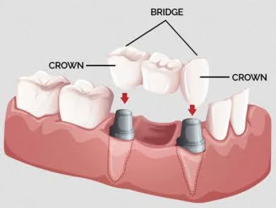 Bridge & crown treatment