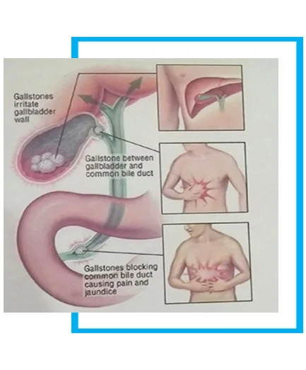 Hernia surgery procedure & repair- inguinal hernia surgery