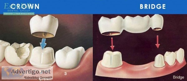 Tooth Crown Replacement