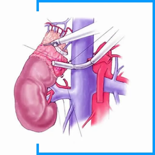 Laparoscopic gallbladder removal surgery in new delhi india