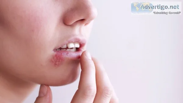 Ayurvedic treatment for genital herpes in uae