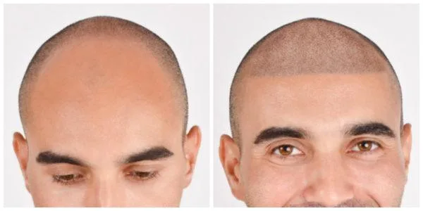 Scalp pigmentation