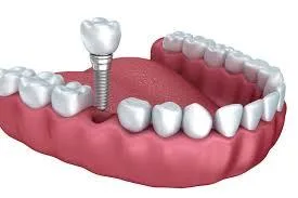 Dental Implants in India