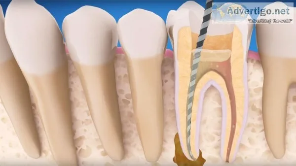 Rotary Endodontics Course  and Endodontics Course India in Affor