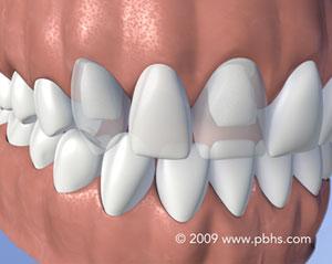 Flipper Tooth Near Me  Columbiascperiodonti st.com
