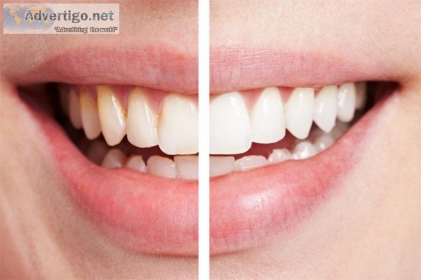 Get Affordable Veneers Cost in sydney