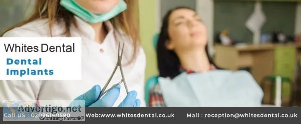 Dental Implants Near Me London SE1 8ER