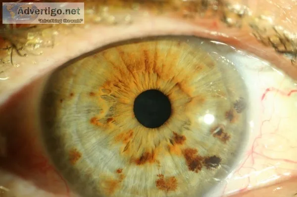Iridology, pain relief naturopath - Dr. Scott