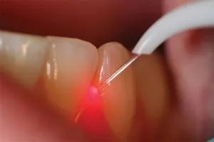 Best Dental implant in Jaipur