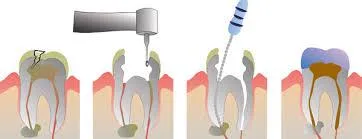 Root Canal Treatment in Noida at City dental Centre