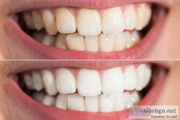 Teeth Cleaning In Griffin