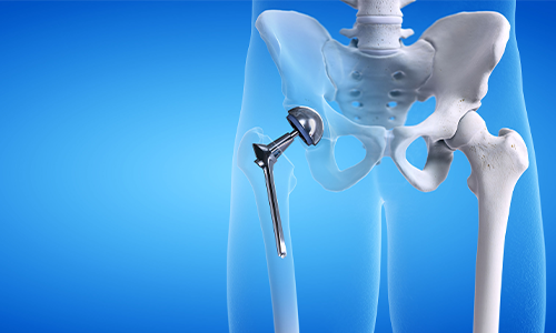 Treat hip arthroscopy in Mumbai- Dr. Pranjal Kodkani