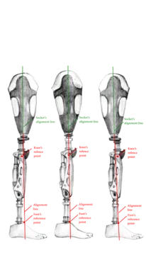 Waterproof Prosthetic Leg by Rinella Prosthetics and Orthotics