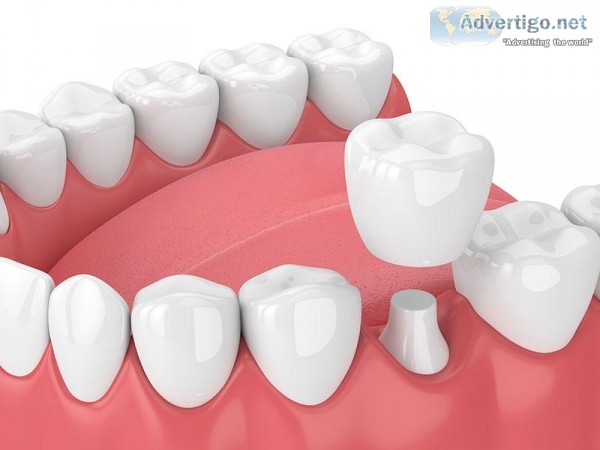 Dental&nbspcrowns in calgary