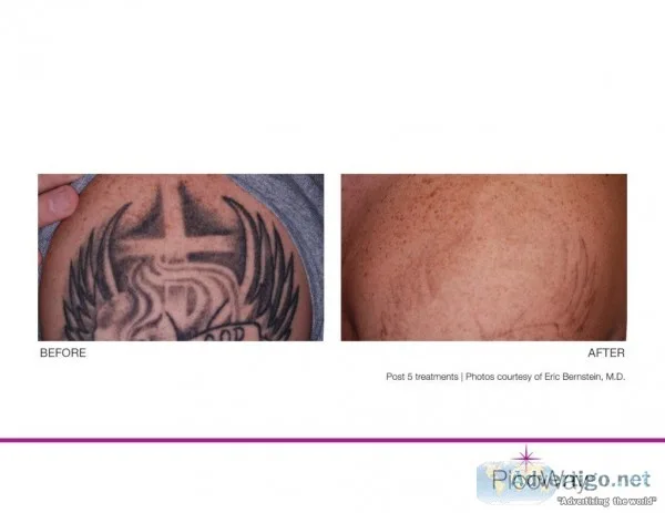 Tattoo removal specialist&nbspToro nto&nbsp&nbsp&nbsp 