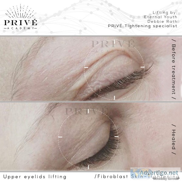 Certified Fibroblast specialist PlasmaTight_byHeathe r