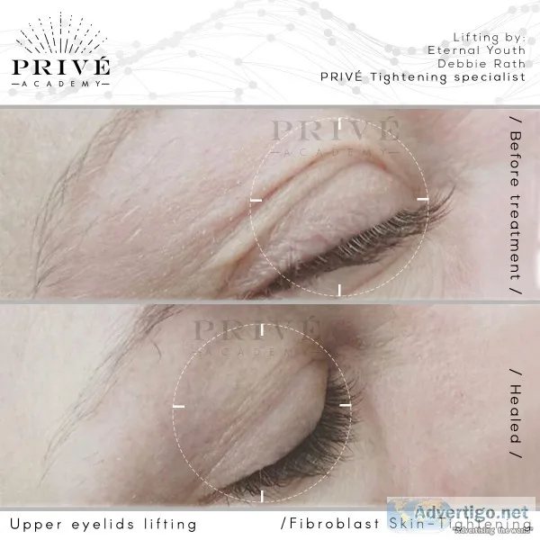 Certified Fibroblast specialist PlasmaTight_byHeathe r