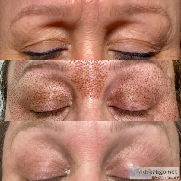 Eyelift fibroblast plasma pen
