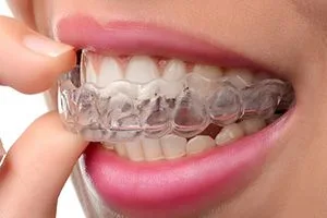 Braces treatment cost