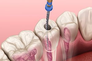 Orthodontic treatment cost